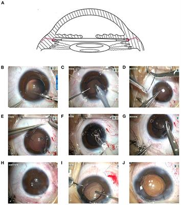 Frontiers | Phacoemulsification Combined With Supra-Capsular and 